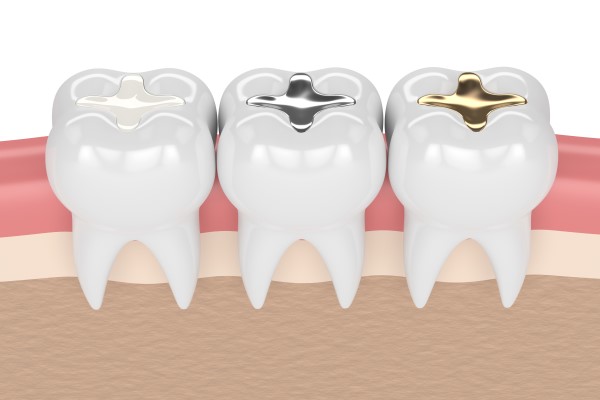 What Is A Silver Dental Filling Made Of?